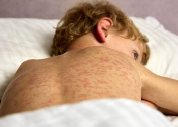 Territorial de Caldas pide revisar el esquema de vacunación, ante casos importados de sarampión en Colombia